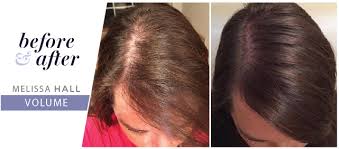 Causes of hair loss after weight loss surgery. Hair Loss Solution