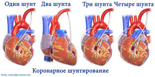 Aortokoronarnoe Shuntirovanie