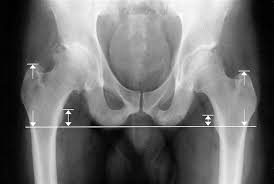 Image result for Functional Leg Length Discrepancy