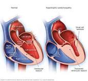 Image result for what is the treatment for hypertrophic cardiomyopathy
