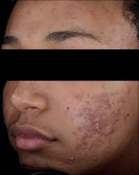 Preventive measures for nodule acne. Systematic Review Of Antibiotic Resistance In Acne An Increasing Topical And Oral Threat The Lancet Infectious Diseases