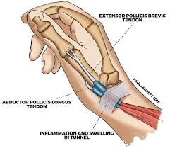 Educational image placeholder: thumb-side wrist pain in De Quervain's tenosynovitis