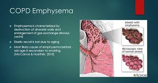 Ex¬tracorporeal life support for posttraumatic acute respiratory distress syndrome at a children's medical center. Copd Asthma And Emphysema Red Pastel E