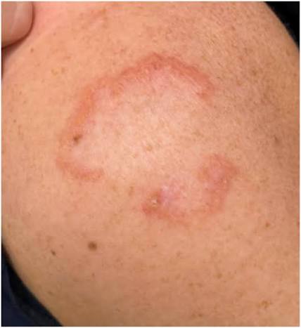 Annular elastolytic giant cell granuloma resolution after pulsed dye laser  - JAAD Case Reports