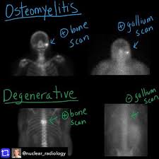 Image result for Osteomyelitis Bone Scan