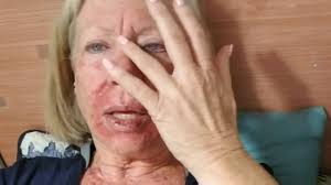 Image courtesy of shadmehr demehri/mgh center for cancer immunology and the cbrc. Fluorouracil Efudex Part 2 Skin Cancer Topical Chemo Youtube