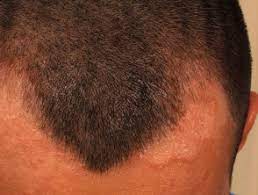 Diagnosis Of Scalp Rashes Dermnet Nz