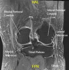 Medical images from an mri allow medical professionals to distinguish body tissues, including the meniscus (shock absorbers in the knee), cartilage, tendons, and ligaments. Snapping Knee Causes Management Complete Orthopedics Multiple Ny Locations