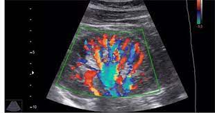 Colour Doppler Test Cost Colour Doppler Ultrasound Price Near Me