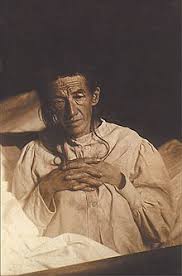 Man kender i dag tre gener, der kan være ændret, så de giver alzheimers sygdom. Alzheimers Sygdom Wikipedia Den Frie Encyklopaedi