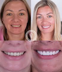 Mr. Hugh Spence selected Acardent Turkey for his treatment. He had All