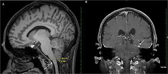 Image result for Incidental Imaging Finding