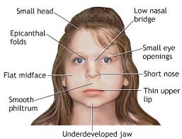 Fetal Alcohol Syndrome Medlibes Online Medical Library