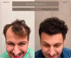 Rekonvalescence po FUE Transplantaci Vlasů