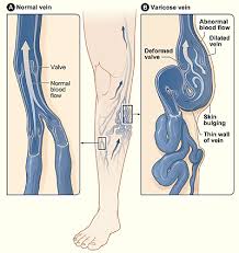 Varicose Veins Clinical Features Management