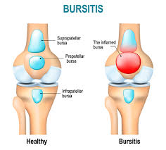 Bursa neden karavan üretim üssü olmasın? What Is Bursitis Wristsupports Co Uk