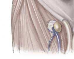 Schenkelhernie Symptome Diagnose Behandlung