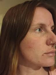 On 4th week of taking sulfasalazine, rheumatology rang me earlier as they  were aware of these itchy spots and rash, been told to stop taking it for a  week until my next