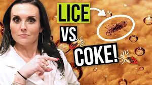 It so, for a 'no scrubbing 4. Removing Head Lice With Coca Cola Coke Watch This Before You Try Youtube