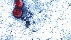 Dozens hospitalized with cyclosporiasis as cases of gastrointestinal illness spike in 31 states