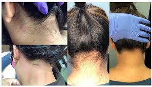 The light of the laser is only attracted to the melanin (pigment) of the hair hence these hair colours cannot be. Laser Hair Removal For Your Back Hairline Amerejuve Medspa