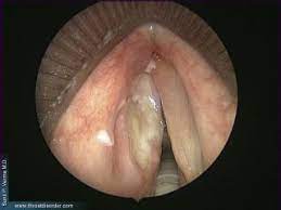 A white or red patch inside your mouth or on your lips may be a potential sign of squamous cell carcinoma. Laryngeal Cancer Diagnosis Symptoms Treatments