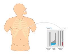 Image result for Chest Tube