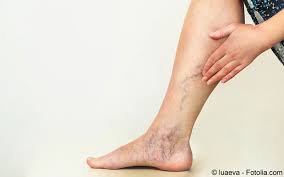 Die krampfader (von althochdeutsch krimpfan ‚krümmen') oder varize (fremdwörtlich varix, plural varizen, älter varicen; Varizen Op Mehr Rezidive Nach Lasertherapie Gelbe Liste