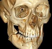 Mandibular fracture - Wikipedia