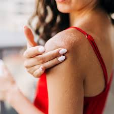Image result for sweat rash on back