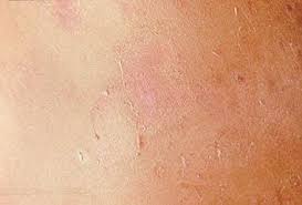 Image result for Pemphigus