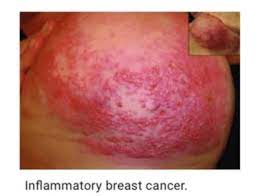 Clinically, inflammatory breast cancer mimics mastitis. Inflammatory Breast Cancer Rash Public Health