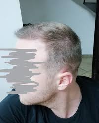 Transplantace Turecko vlastní zkušenost