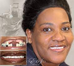 Unlike ohip dental coverage which you access automatically using your ohip card, to qualify for the above free dental programs you need to apply first. Dental Implants Brooklyn Affordable Teeth Implants Implant Dentist
