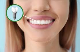 Everything You Need to Know About Dental Implants