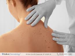 But cancer cells are different. The Difference Between Moles And Freckles Walk In Dermatology