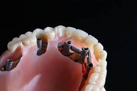 Image result for dentures