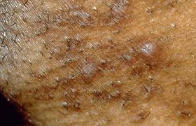They look like a dark shadow under the skin. Acne Like Breakouts Could Be Folliculitis