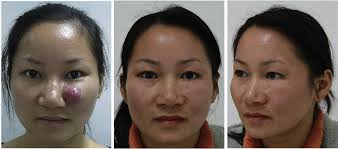 Reconstruction of skin defects in the medial cheek using lateral cheek  rotation flap combined with Z-plasties.