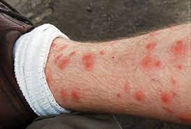 Shutterstock why does it work? Chigger Bites What Chigger Bites Look Like How To Treat Them