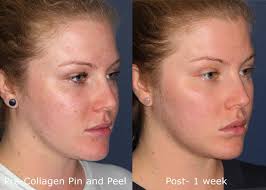 It is one of the best skin lightening peels as it helps in the removal of acne scars, blackheads. Chemical Peel Medical Spa San Diego Ca Clderm