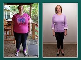 Gastric sleeve surgery is increasingly becoming an important option for people who would like to undergo weight loss surgery. Weight Loss Bariatric Surgery In Nc Firsthealth Of The Carolinas