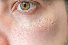 Setelah kemerahan memudar timbul bercak putih di kulit (hipopigmentasi). 4 Penyebab Bintik Putih Atau White Spots Di Wajah