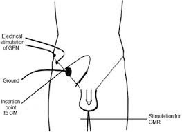 Image result for Cremasteric Reflex