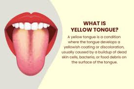 Image result for yellow tongue infection