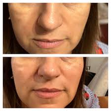 Face Filler, 2025 Face Filler Cost in Turkey
