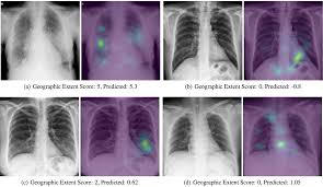 Conclusion of living anatomy of the chest congratulations! Cureus Predicting Covid 19 Pneumonia Severity On Chest X Ray With Deep Learning