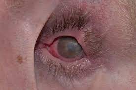 Procedure May Restore Stevens Johnson Affected Eyes Dermatology Advisor