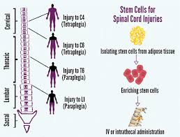 However, the good news is that there are stem cell therapies available for alopecia areata in delhi, india that are committed to providing satisfactory results for the disease. What Is Stem Cell Therapy Cost In India Clinicspots