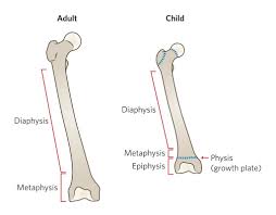 Image result for Fractures in Children